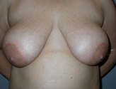 Patient # 82406 Before Photo # 1